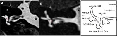 Confrontation of endolymphatic hydrops diagnosis on 3-Tesla MRI to clinical and audiovestibular findings in Meniere's disease